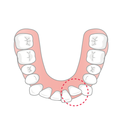 歯が内側に入っているイラスト